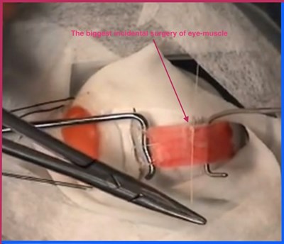 The biggest incidental surgery of eye-muscle „m.rectus medialis and m.rectus lateralis” causes that you cannot start symmetrybody-concept.