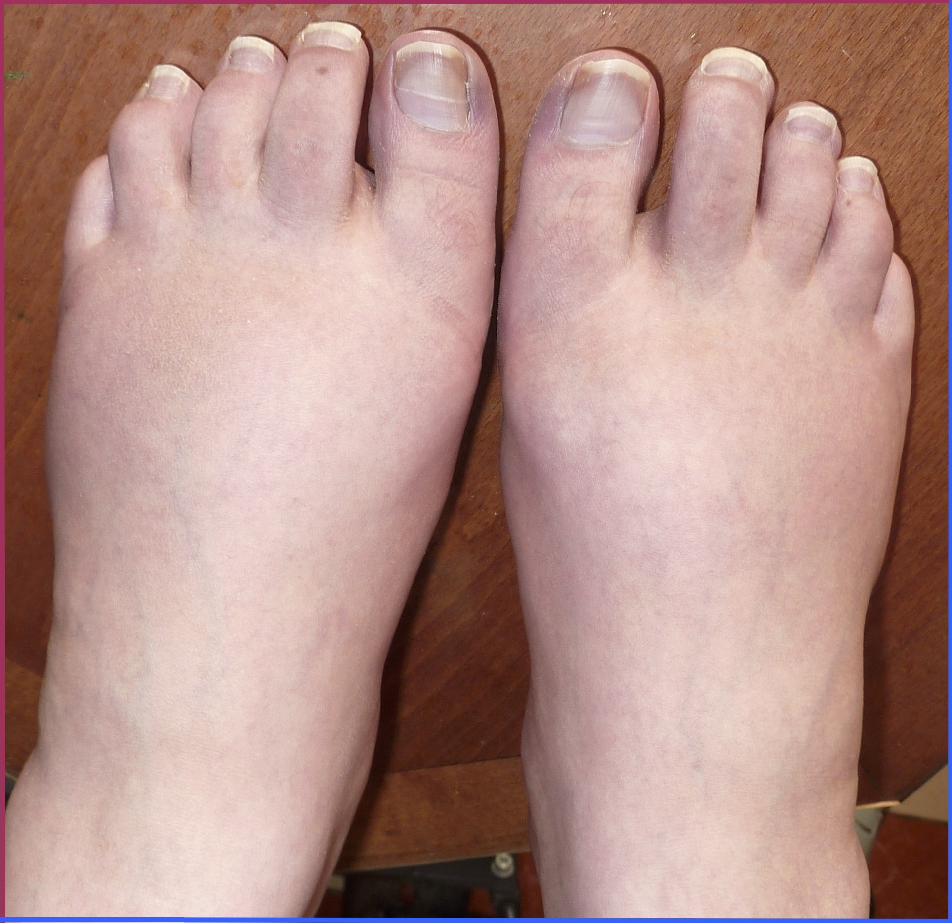 Hammer Toe