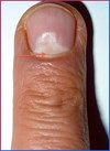 Asymmetrybody causes dent in the nails-SYMMETRYBODY
