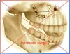 Incidental surgery; operation upper jaw and lower jaw (malocclusion)