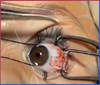 Incidental strabismus surgery