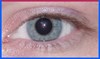 Recovered= Keratoconus: Eye: Corneas will protrude and the actual distance between the cornea and the retina becomes bigger. This causes images of faraway objects to become blurry and closer objects to be clearly visible. This form of myopia can deteriorate as the keratoconus develops- SYMMETRYBODY