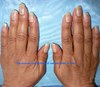 The recovery percentage of nail psoriasis is %98- SYMMETRYBODY