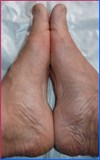 The recovery percentage of hallux valgus is 98,5%. - SYMMETRYBODY